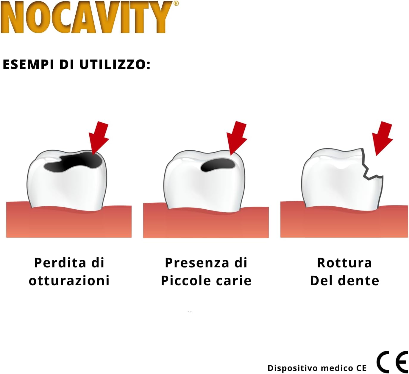 Nocavity Kit per Otturazioni Dentali Provvisorie - Cemento che Isola la ...